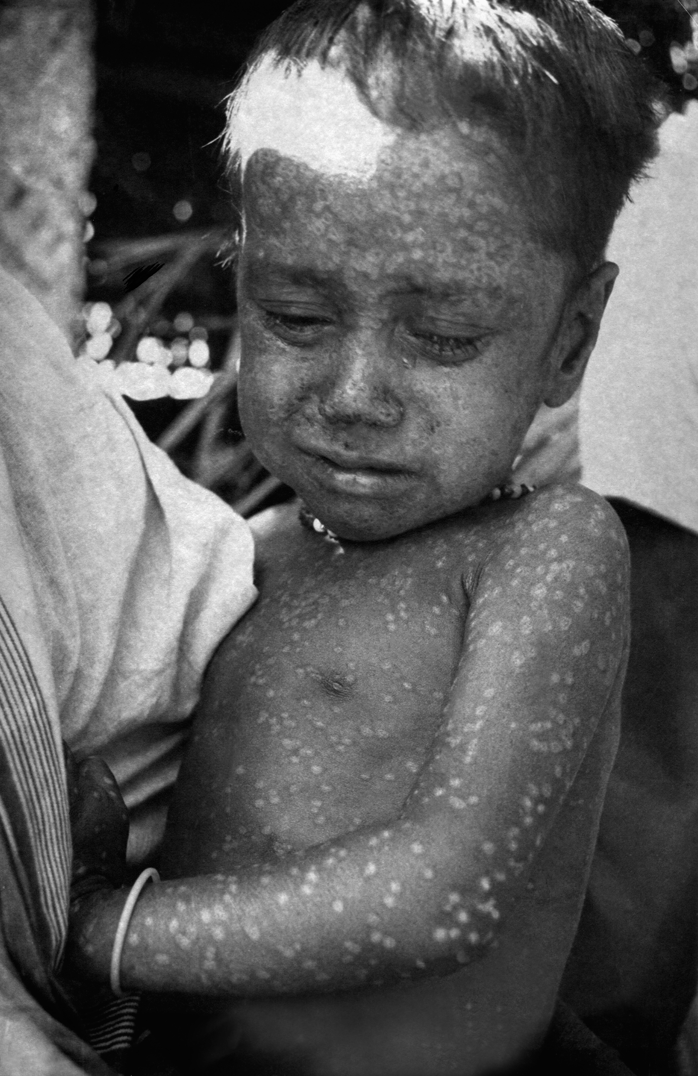 3. The Wrath of Smallpox (image credits: wikimedia)